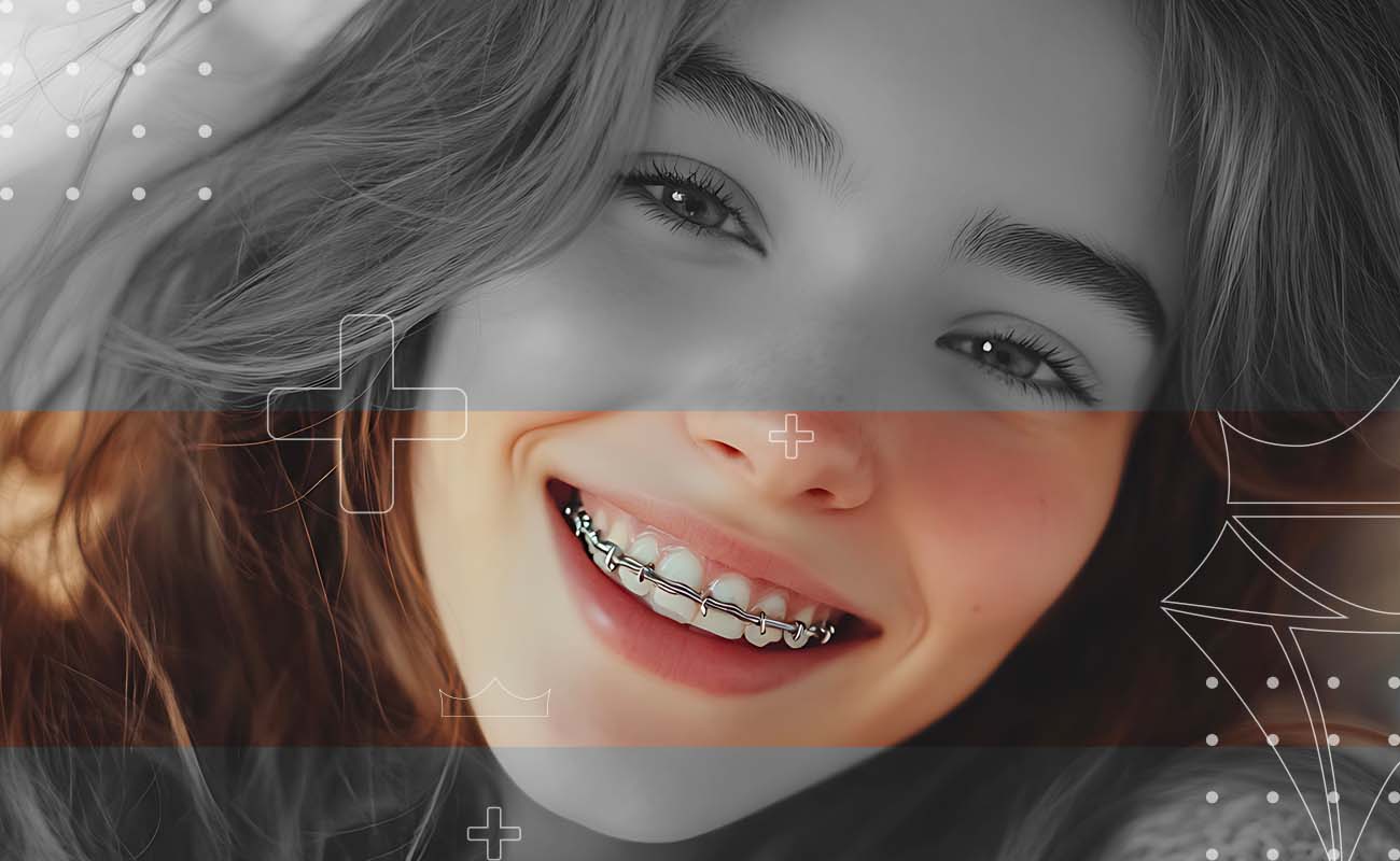 SaphireDent-LingualBraces-01