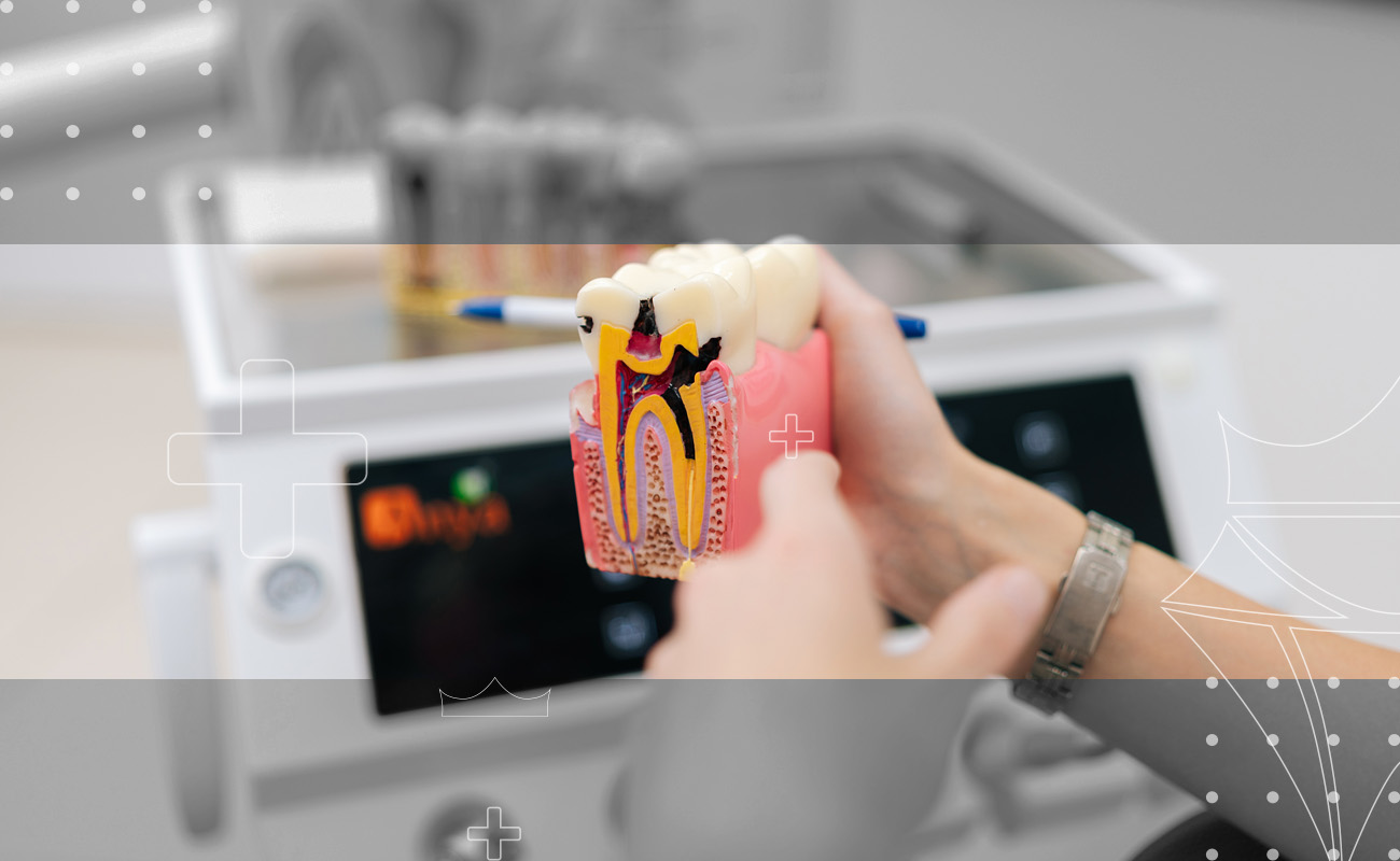 SaphireDent-Root-Canal-02