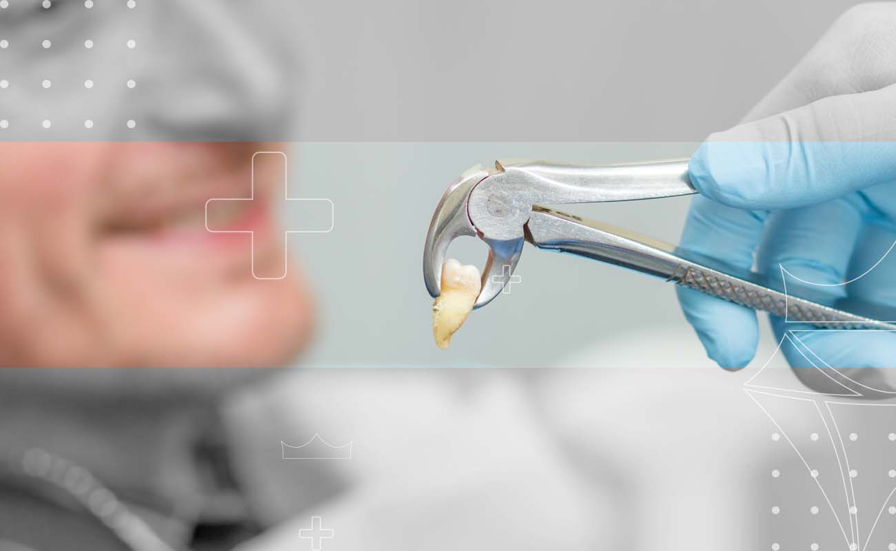 SaphireDent-Tooth-Extraction-03